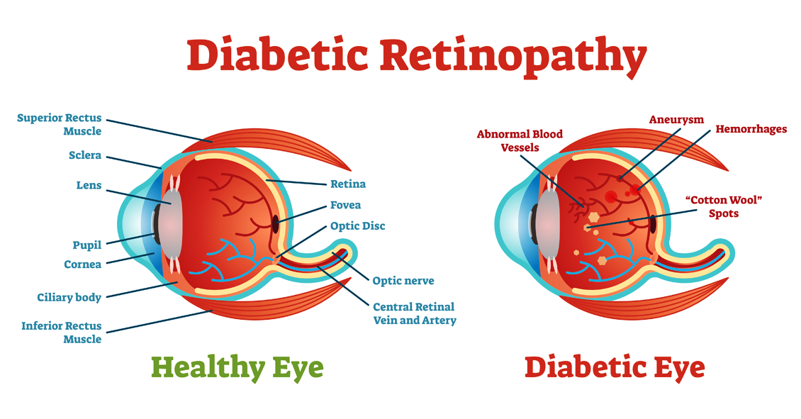 Basic Info on Diabetic Retinopathy